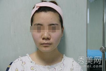 大三女生博客揭示整容手术的全过程(照片)