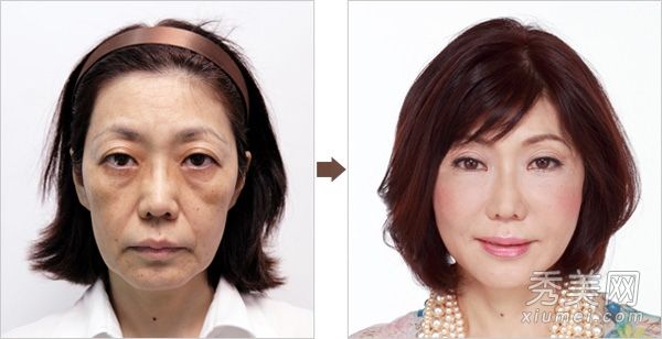 日本整形医院让25组女性接受整形手术