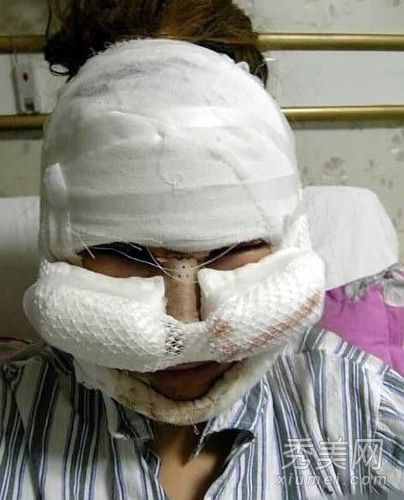 没有瑕疵的整形手术?组图揭示操作过程