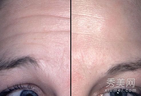 什么是微整形?整形手术前后的效果比较