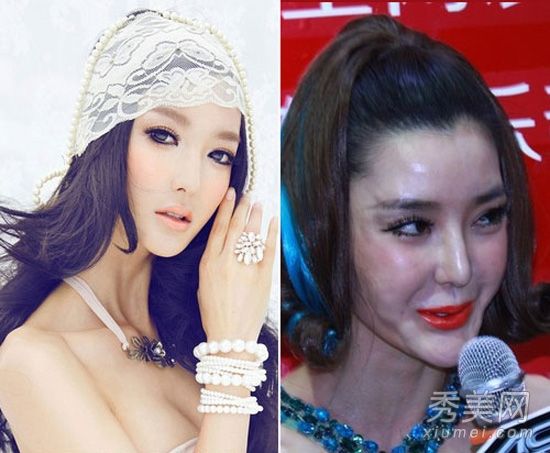 李颖芝怀疑整形手术失败,骨伤后遗症和鼻子扩大暴露