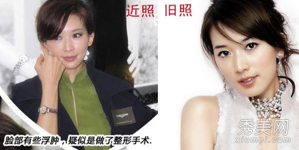 女演员的整形手术后遗症出现小林强·吉玲的脸未被认出