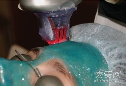 揭示医学之美:激光去痘和皱纹高清对比图