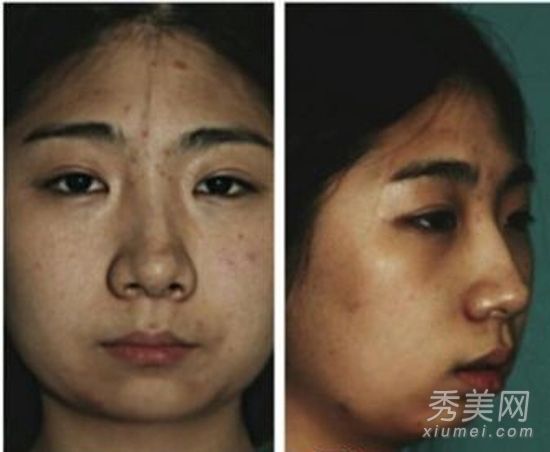 七个普通人整容揭示对比整容项目的秘密