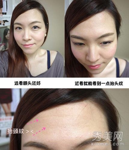 网友自曝微整形肉毒杆菌毒素除皱工艺流程图