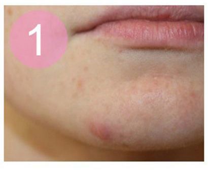 新年期间如何治疗痤疮？教你痤疮化妆遮瑕膏教程