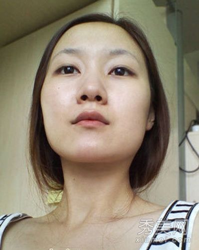 整形手术前后效果图饼脸颧骨整形尖脸