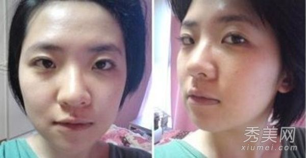 整容经历:网友隆鼻前后的自我暴露