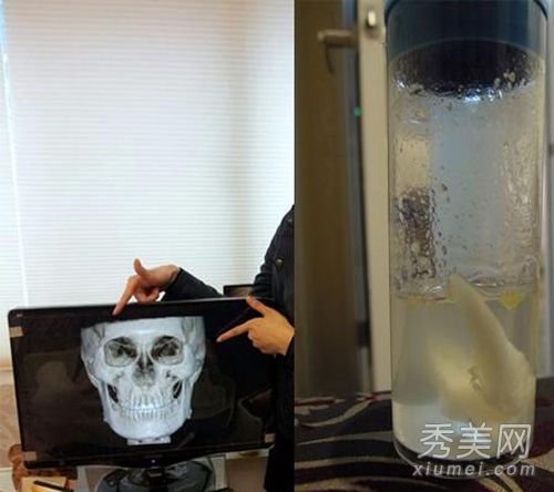 整形手术经验:台湾热妈妈的骨切割与整形手术之比较