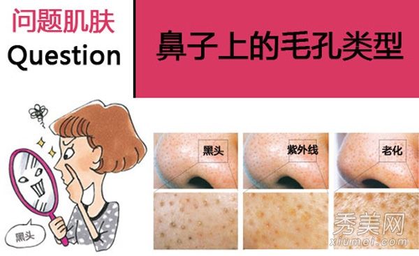 为期7天的毛孔护理项目去除了鼻子上的黑头