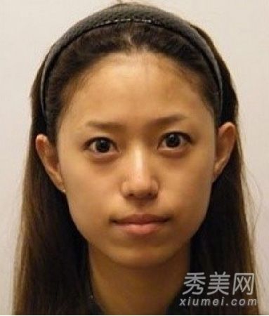 整形手术经验:整形手术前后鼻整形+面部脂肪移植