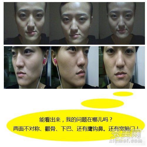 韩国女孩崔小山的面部整形手术(照片)