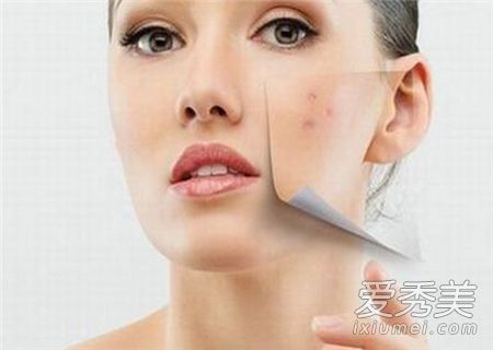 为什么脸上长粉刺？疾病写在脸上。