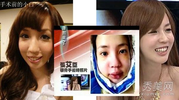 龅牙MM整形手术与颌骨整形手术+矫正龅牙