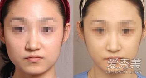 如果你经常吃硬东西，咬肌会变大吗？咬肌是如何变小的？