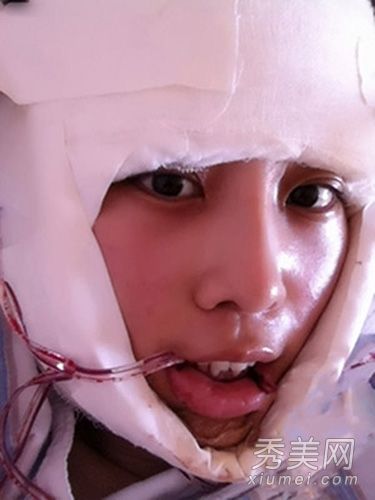 整容经历:照片揭示网民下巴整形过程