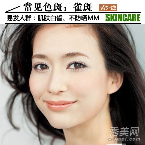 雀斑和黄褐斑教你正确分类雀斑和美白