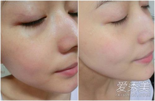 如何避免粉刺？如何去除粉刺