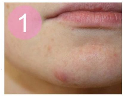 圣诞节快到了。我怎样才能弥补粉刺？