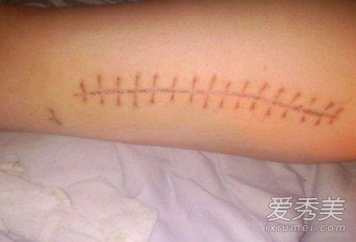 什么去疤产品效果好？去疤产品排名表