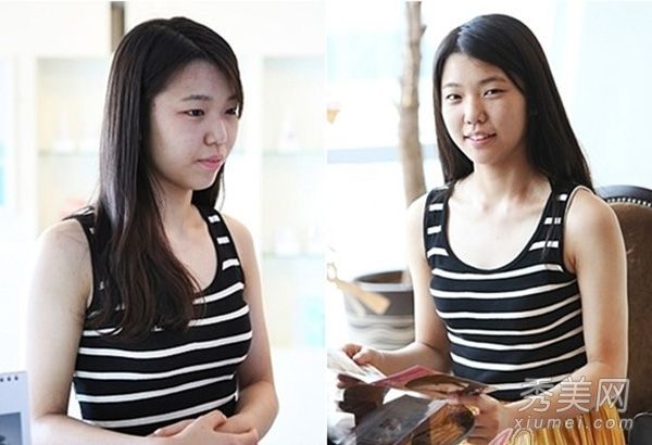 整容案例:韩国MM整容手术前后