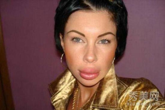 照片显示一名女子在整形手术失败后更换了她的香肠嘴。