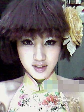 整形手术经验:睁眼+割双眼皮手术经验