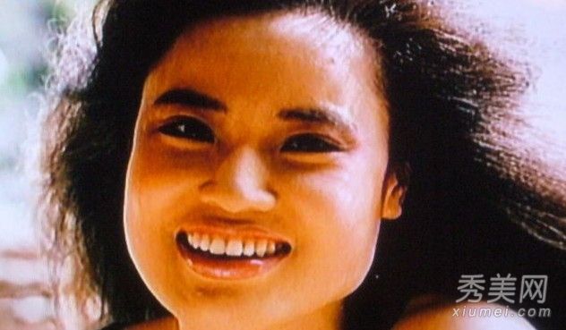 整容手术失败案例:韩国女性在10次整容手术中变形