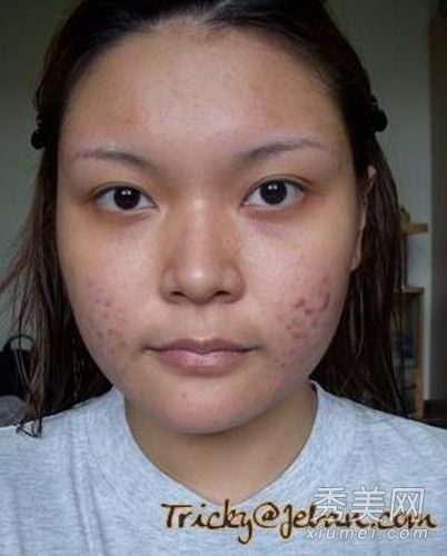 痤疮皮肤模特史上的神奇化妆师