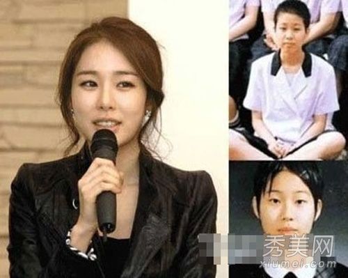 韩国女演员第二次整容失败