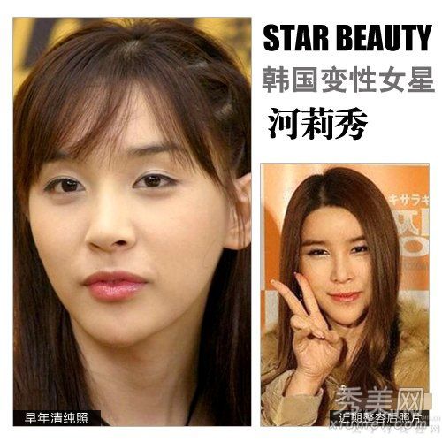 河莉秀整形手术失败和畸形教你7种整容手术来修复脸型