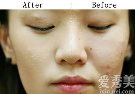 如何弥补脸上的粉刺？遮瑕膏技巧的现场演示