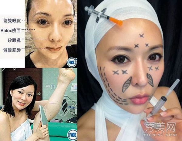 陈丽敏小强30次输港姐整容揭示整容后遗症