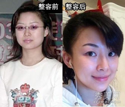 九天后整形手术前后潘晓婷的比较