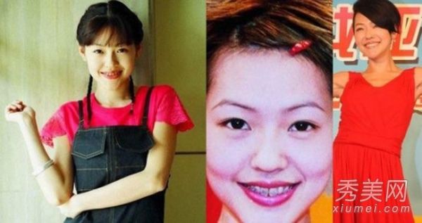 人生中的第一次“整形手术”