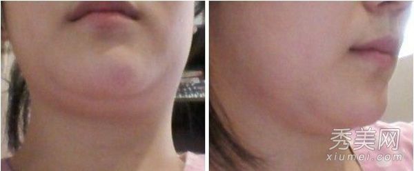 准新娘接受面部整形手术。大腿吸脂过程