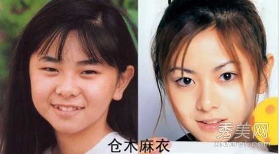 16位日本明星面部微整形手术细节揭晓