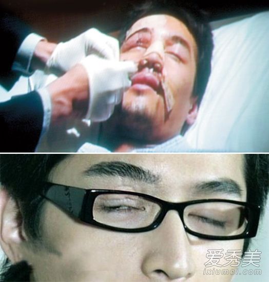 2006年手术照片曝光10年后，休的右眼仍不完整