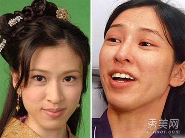 明星整容:TVB陈思琪整容高清图片