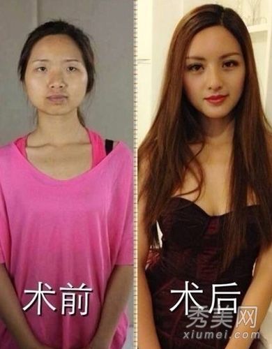 整形手术的过程在微博上直播前后完全不同。