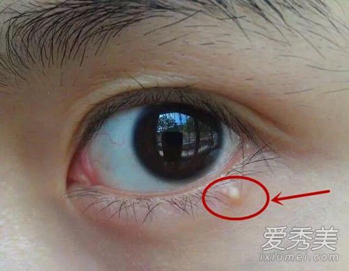 三分钟来识别脂肪颗粒，并轻松处理和告别脂肪颗粒