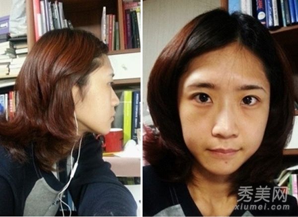 20天隆鼻+面部脂肪填充真实美容记录