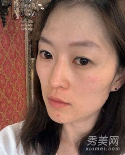 整容经历:黄脸女人面部脂肪移植成女孩