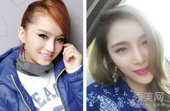 09快女李媛希将整形手术改名为截骨术，面部畸形过度