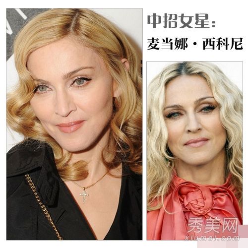 如何治疗女明星的颈部线条、黑斑和皮肤问题
