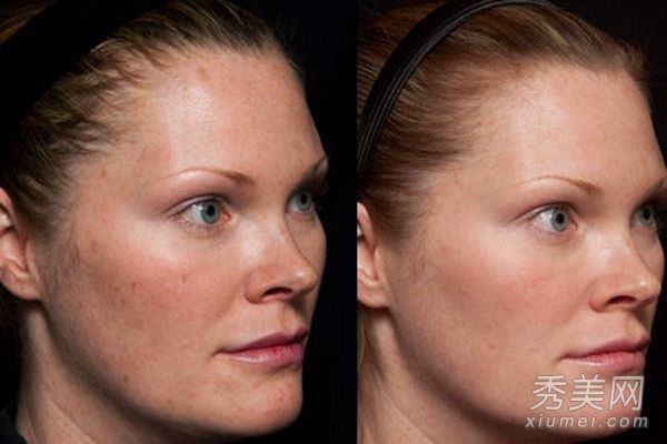 激光美容能有效去除雀斑和皱纹吗?