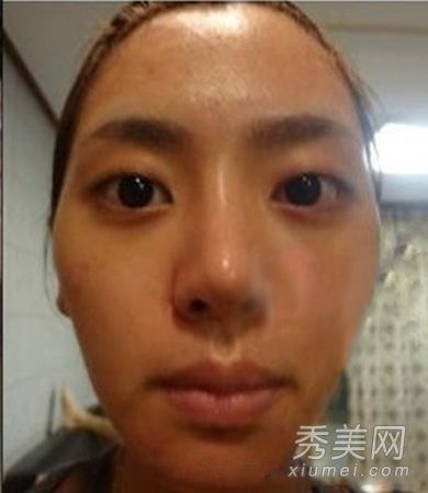 磨骨术后高颧骨美容手术的恢复效果