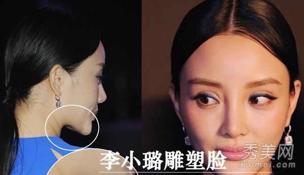 死亡不承认整形手术地图揭示李小璐疑似整形手术部位