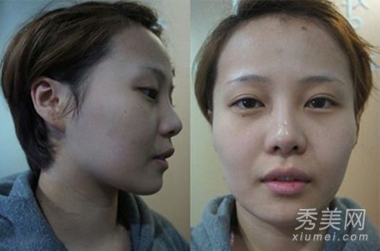 老年人面部轮廓塑造的个案研究