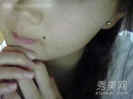 激光去痣会留下疤痕吗？网民揭露激光除痣的全过程。